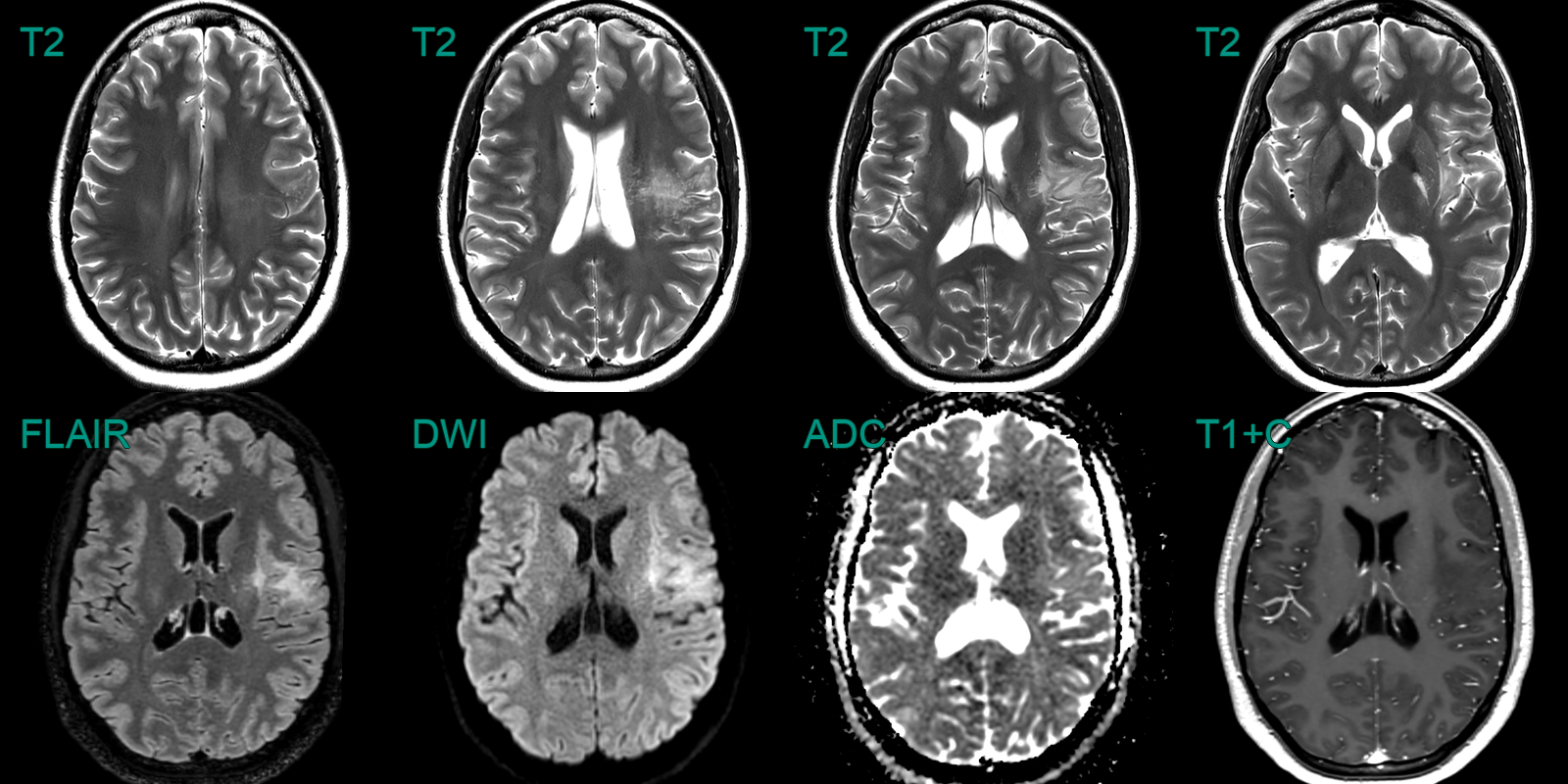 Multinodular and Vacuolating Neuronal Tumour (MVNT) NEURORADIOLOGY