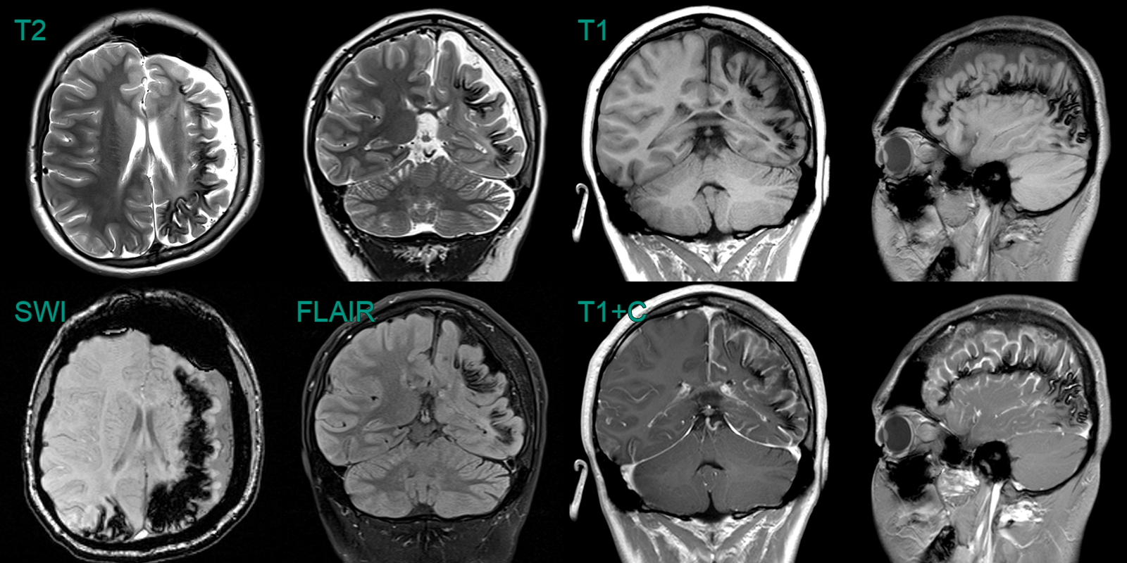 Sturge weber syndrome neuroradiology